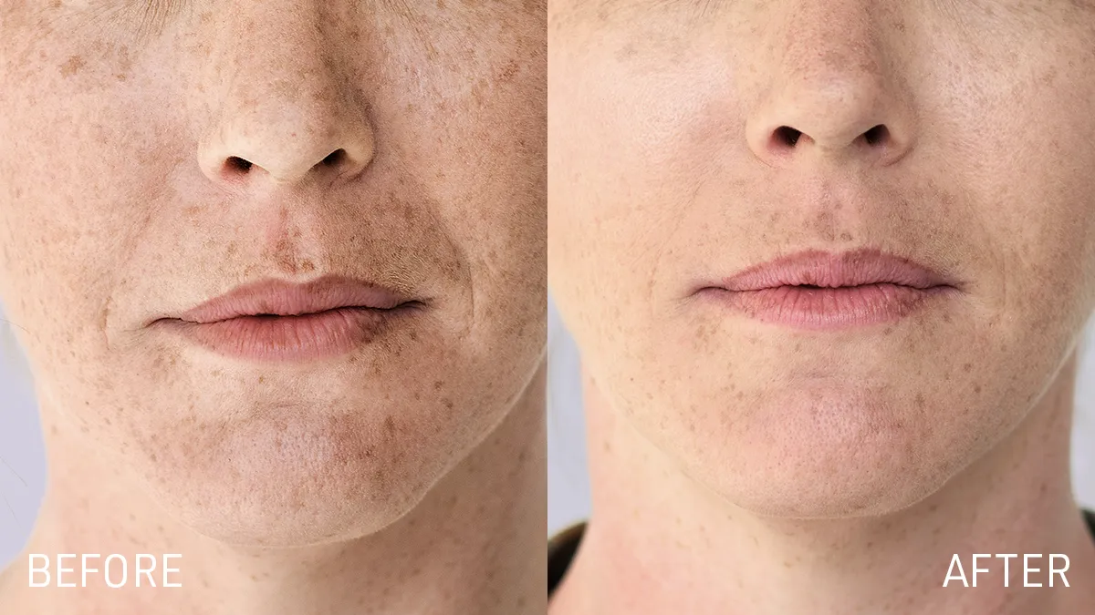 FAQ red light therapy panel before and after on a lower part of a woman's face